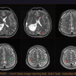 Funkční vyšetření mozku s možností zobrazení různých mozkových center (nejčastěji pohybové, řečové či smyslové). Zobrazení motorického (pohybového) centra (spodní snímky) u pacienta s objemným tumorem pravé mozkové hemisféry. 