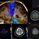 Funkční vyšetření mozku s možností zobrazení různých mozkových center (nejčastěji pohybové, řečové či smyslové) a drah spojujících tato centra a ostatní orgány. Nahoře vlevo: MR traktografie. Menší obrázky: zobrazení mozkových center (barevné okrsky) v kombinaci s jinými technikami (CT či MR).