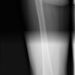 snímek stehenní kosti