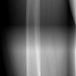 snímek stehenní kosti